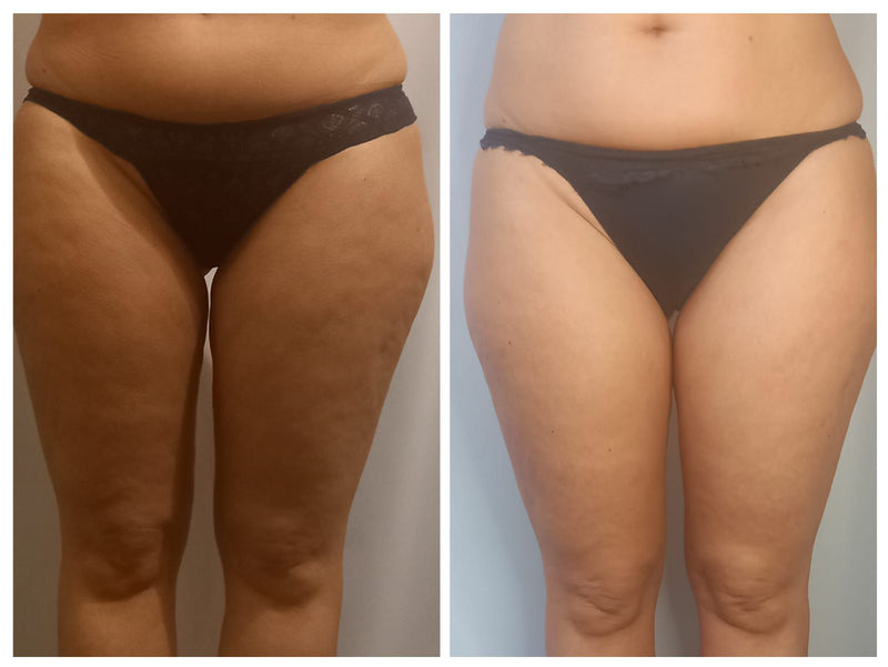 Risultati Cellulite Reset